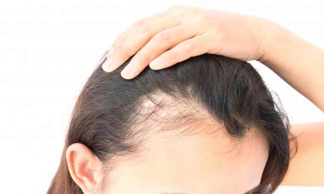 Best Alopecia Areata Treatment in Mumbai | Alopecia Areata Specialist Doctor,  Cost in Bandra