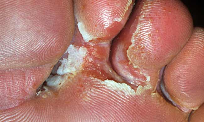 Fungal Infections