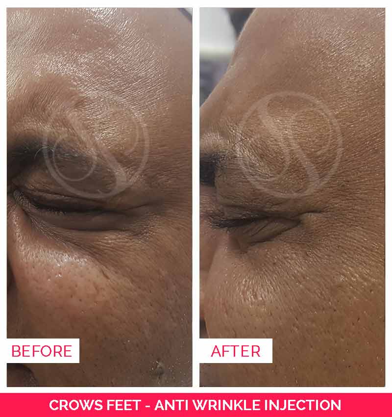 crows feet before and after, coolsculpting in bangalore, Ultherapy treatment in bangalore