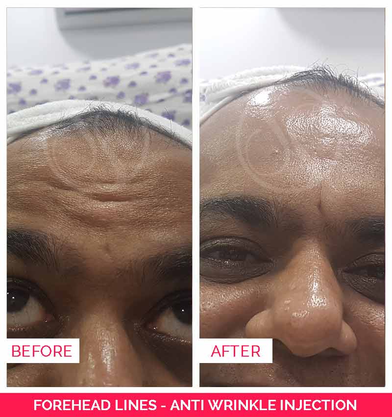 forehead lines before and after
