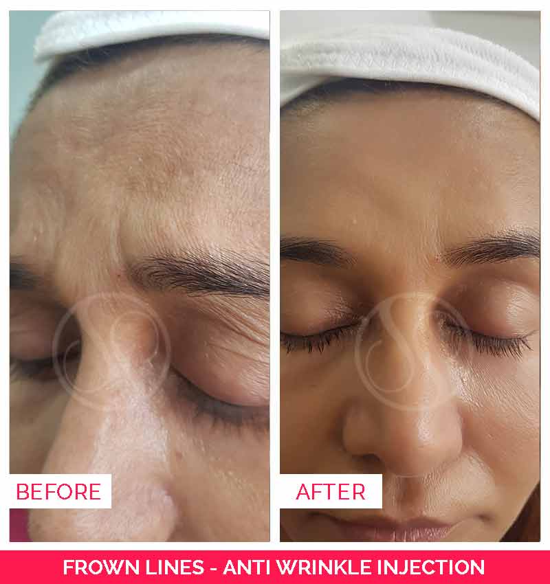 frown lines before and after, coolsculpting in bangalore, Ultherapy treatment in bangalore
