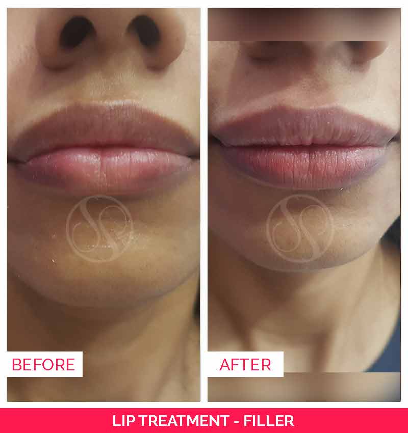 lip fillers before and after, coolsculpting in bangalore, Ultherapy treatment in bangalore