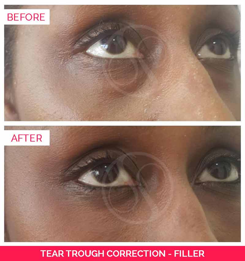 tear trough correction filler before and after