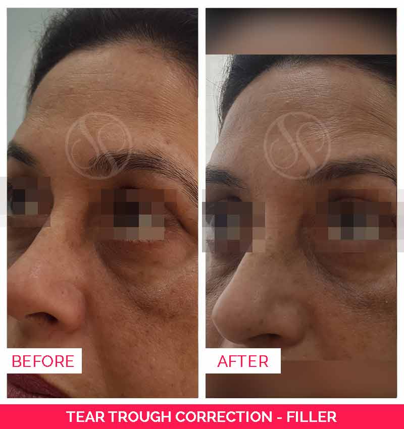 Before and after tear trough fillers, coolsculpting in bangalore, Ultherapy treatment in bangalore