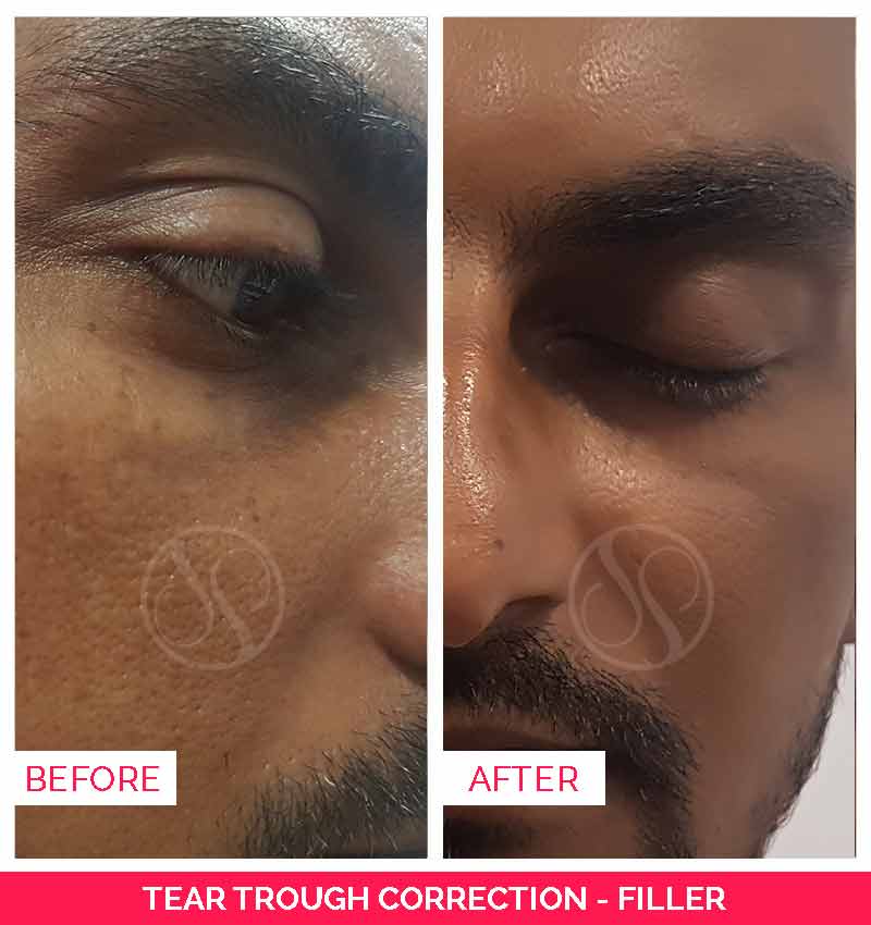 Tear Trough Fillers Before and after