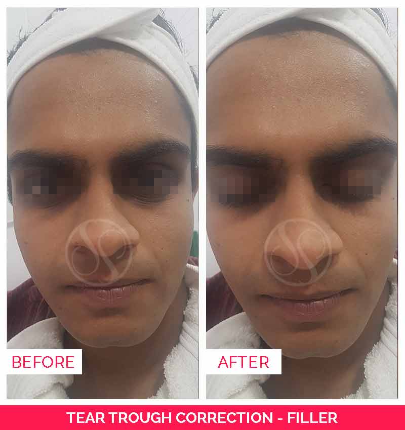 Before and after tear trough fillers, coolsculpting in bangalore, Ultherapy treatment in bangalore